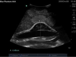 Abdominal aortic aneurysm µltrasound training model
