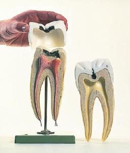 Somso® Molar With Cavities Model