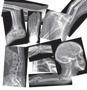 Bones X-Rays
