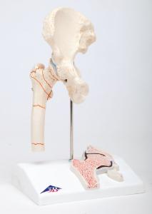 3B Scientific® Femoral Fracture And Hip Osteoarthritis