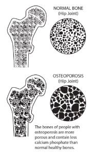 Science Take-Out® Brittle Bones: A Density Problem