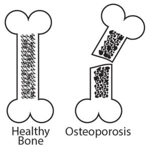 Science Take-Out® Brittle Bones: A Density Problem