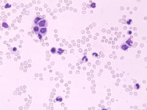 Chronic Myelogenous leukemia-Granulocytic Slide