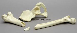 BoneClones® Human Female, Blunt Force Trauma - Innominate and Femur Set