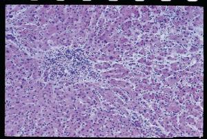 Cirrhosis, Section, Hematoxylin and Eosin Stained Slides