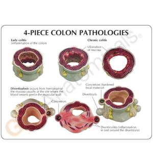 GPI Anatomicals® Colon Pathology Model