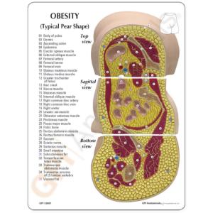 GPI Anatomicals® Obesity Model