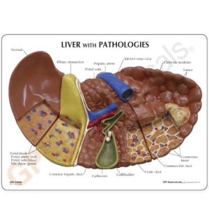 GPI Anatomicals® Liver Pathology Model