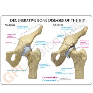 GPI Anatomicals® Arthritic Hip Model