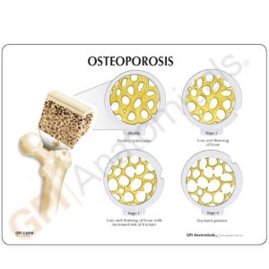 GPI Anatomicals® 4-Stage Osteoporosis Disk Set
