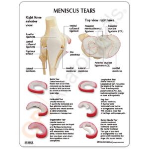 GPI Anatomicals® Meniscus Knee Model
