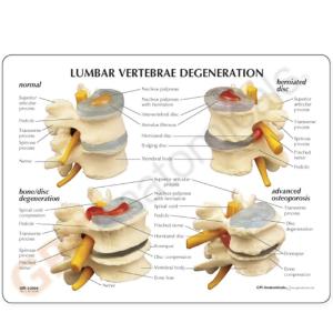 GPI Anatomicals® 4-Stage Vertebrae Model