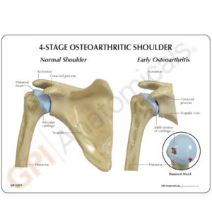 GPI Anatomicals® Osteoarthritis Stages Model