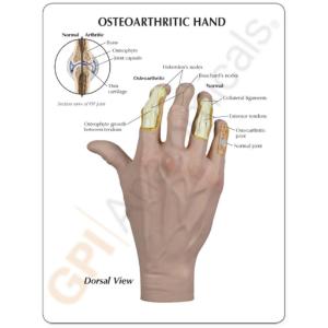 GPI Anatomicals® Osteoarthritis Hand Model
