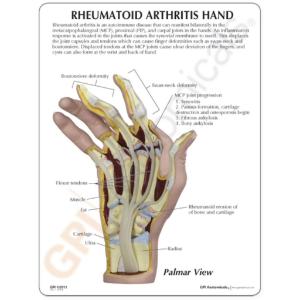 GPI Anatomicals® Rhumatoid Arthritis Hand Model