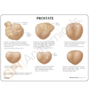 GPI Anatomicals® Prostate Disease Model