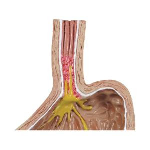 GPI Anatomicals® GastroEsophageal Reflux Disease (GERD)