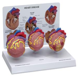 GPI Anatomicals® Heart Disease  Model Set