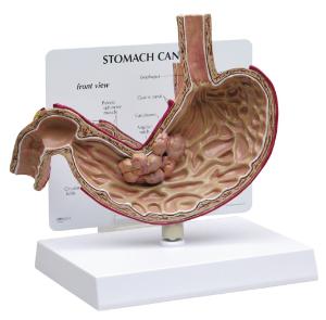 GPI Anatomicals® Stomach Cancer Model