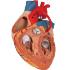 Heart with Bypass