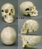 BoneClones® Human Female Skull with Multiple Gunshot Wounds