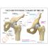 GPI Anatomicals® Arthritic Hip Model